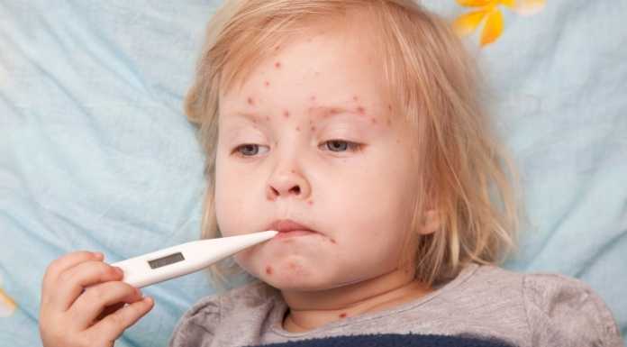 อาการของโรคอีสุกอีใสสามารถแบ่งได้เป็น 3 ระยะ